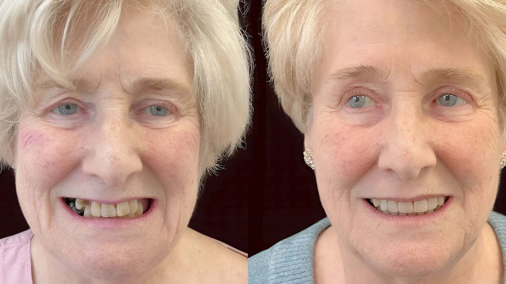 Before-and-after patient smile shown in Genix Healthcare content